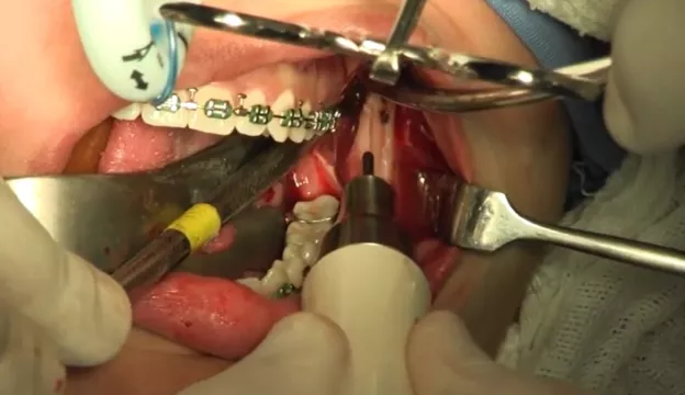 CMF - Chirurgie orthognatique côté gauche, Dr Colucci