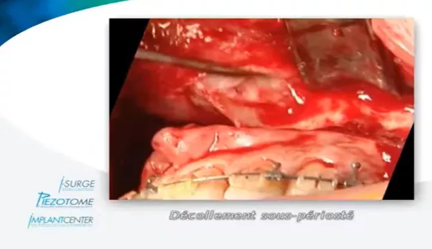 CMF – Chirurgie orthognatique, Dr Solyom